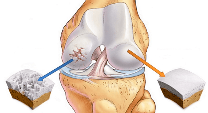 artrozdan ta'sirlangan sog'lom xaftaga va xaftaga