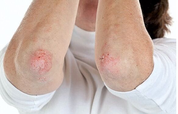 Psoriazisli odamlar psoriatik artritga moyil