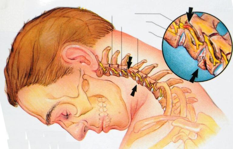 servikal osteoxondroz bilan nima sodir bo'ladi
