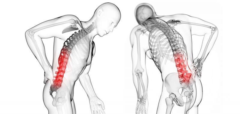 servikal osteoxondroz bilan asoratlar