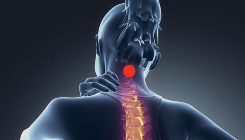 servikal osteoxondrozning belgilari